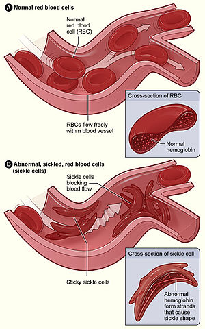 Sickle cell 01